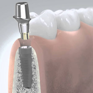 CAMLOG titanium base implant solution