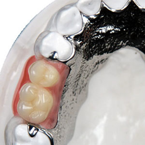 Metal frame dentures