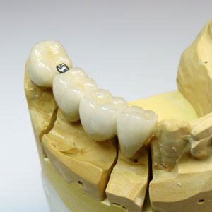 Key wave dove tail dental restoration