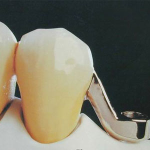 Dental precision attachments