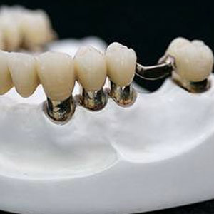 Telescopic dental crowns