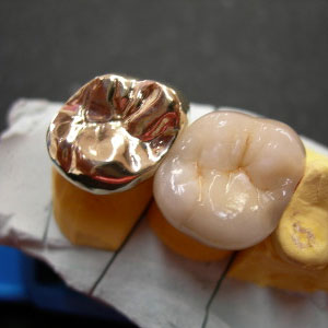 Semi precious dental alloy