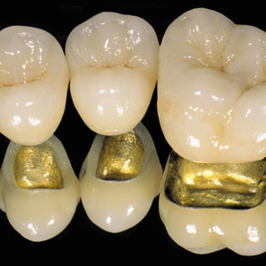 Capek gold dental composite